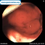 videocapsule-endoscopy-vce-in-glanzmanns-thrombasthenia