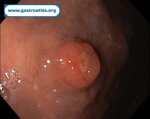 gastric-net-in-atrophic-gastritis