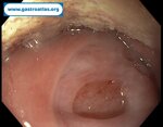 tonsil-lymphoma