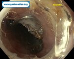 esophageal-stricture-secondary-to-amyloidosis-part-2