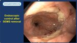 over-the-scope-clip-and-sems-a-comprehensive-treatment-for-failed-peroral-endoscopic-myotomy-in-idiopathic-achalasia