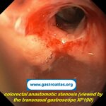colorectal-anastomotic-stenosis