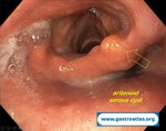 laryngeal-serous-cysts-can-miming-symptoms-of-reflux-disease-gerd