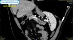 pancreatic-adenocarcinoma-abdominal-us-ct-scan-eus-fnb-and-surgery-imaging