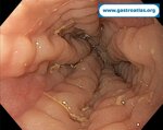 eosinophilic-esophagitis
