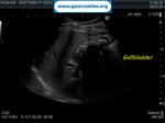 choledocholithiasis-ercp