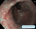 collagenous-gastritis
