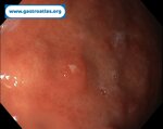 gastric-net-in-atrophic-gastritis