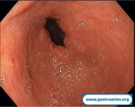 collagenous-gastritis