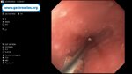 esophageal-stricture-in-endometrial-cancer