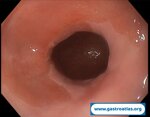barrett-esophagus