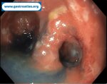 pre-anastomotic-fistula-in-colorectal-anastomosis-part-1-endoscopic-view