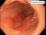 argon-plasma-coagulation-apc-treatment-of-gastric-antral-vascular-ectasia-gave