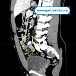 meckels-diverticulum