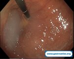 esophagus-food-bolus-obstruction
