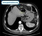 gastric-metastasis-from-renal-cell-carcinoma