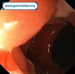 colorectal-anastomotic-stenosis