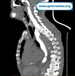 esophageal-stenosis-secondary-to-amyloidosis-part-1