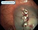 hemostatic-clip-a-fundamental-tool-in-endoscopy
