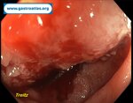 small-bowel-adenocarcinoma-sba-resulting-from-undiagnosed-celiac-disease