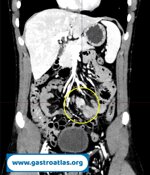 meckels-diverticulum