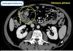 jejunal-hemangioma