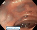 blue-rubber-bleb-nevus-syndrome-brbns