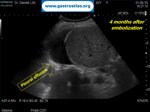 percutaneous-liver-biopsy-hematoma
