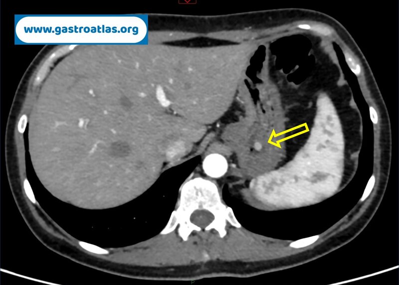 gastric-net-in-atrophic-gastritis