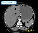small-bowel-adenocarcinoma-sba-resulting-from-undiagnosed-celiac-disease