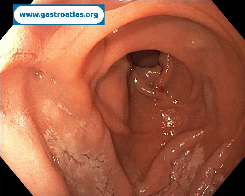 duodenal-adenoma