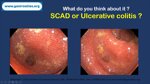 medical-quiz-scad-or-ulcerative-colitis