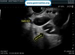 cystic-duct-stone-mrcp-and-eus