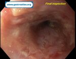 esophageal-stricture-secondary-to-amyloidosis-part-3-sems-removal