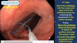 endoloop-polypectomy-tips-and-tricks