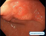 argon-plasma-coagulation-apc-treatment-of-gastric-antral-vascular-ectasia-gave