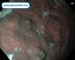 gastric-net-in-atrophic-gastritis