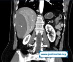 percutaneous-liver-biopsy-hematoma