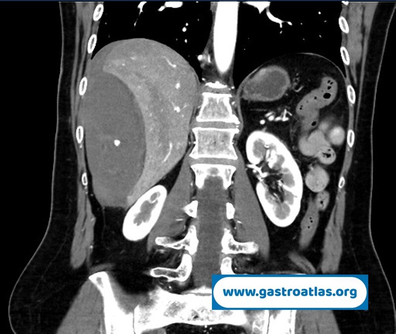 percutaneous-liver-biopsy-hematoma