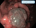 gastric-metastasis-from-renal-cell-carcinoma