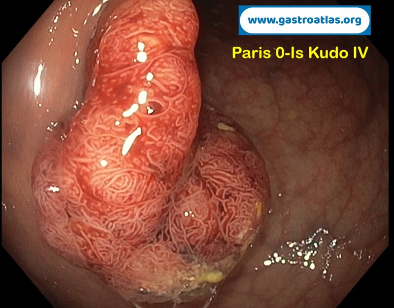 post-polypectomy-bleeding-coagrasper-use