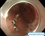 advancing-esophageal-motility-treatment-with-poem-and-endoflip