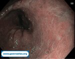 collagenous-gastritis