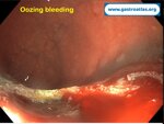 post-polypectomy-bleeding-coagrasper-use