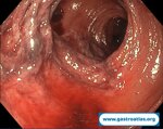 colon-ischemic-colitis-case-2-intermediate-stage