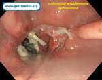 dehiscence-of-colorectal-anastomosis-anastomotic-leak