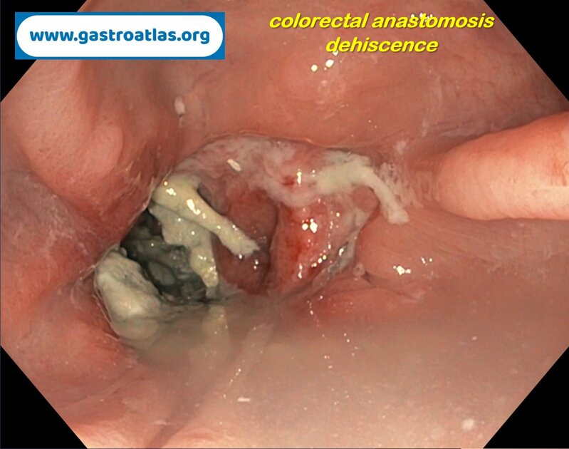 dehiscence-of-colorectal-anastomosis-anastomotic-leak