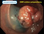 post-polypectomy-bleeding-coagrasper-use
