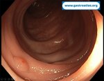 colonic-inverted-diverticulum-icd