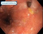 pre-anastomotic-fistula-in-colorectal-anastomosis-part-1-endoscopic-view
